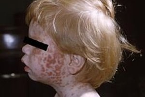 Rubella Igg Positive Means