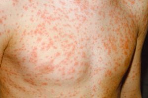 Rubella virus symptoms