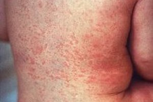Rubeola e causada por virus ou bacteria